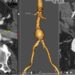 Aneurisma aórtico abdominal, amenaza silenciosa y desconocida potencialmente mortal