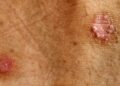 31 millones de personas en México viven con alguna enfermedad de la piel. ¿Cómo reconocer la Hidradenitis Supurativa?