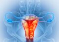 Cáncer ginecológico: tratamientos menos agresivos con la misma eficacia