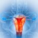 Cáncer ginecológico: tratamientos menos agresivos con la misma eficacia